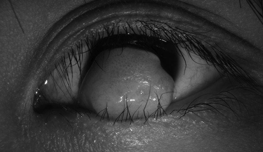 Closeup view of an eye with a tumor in it