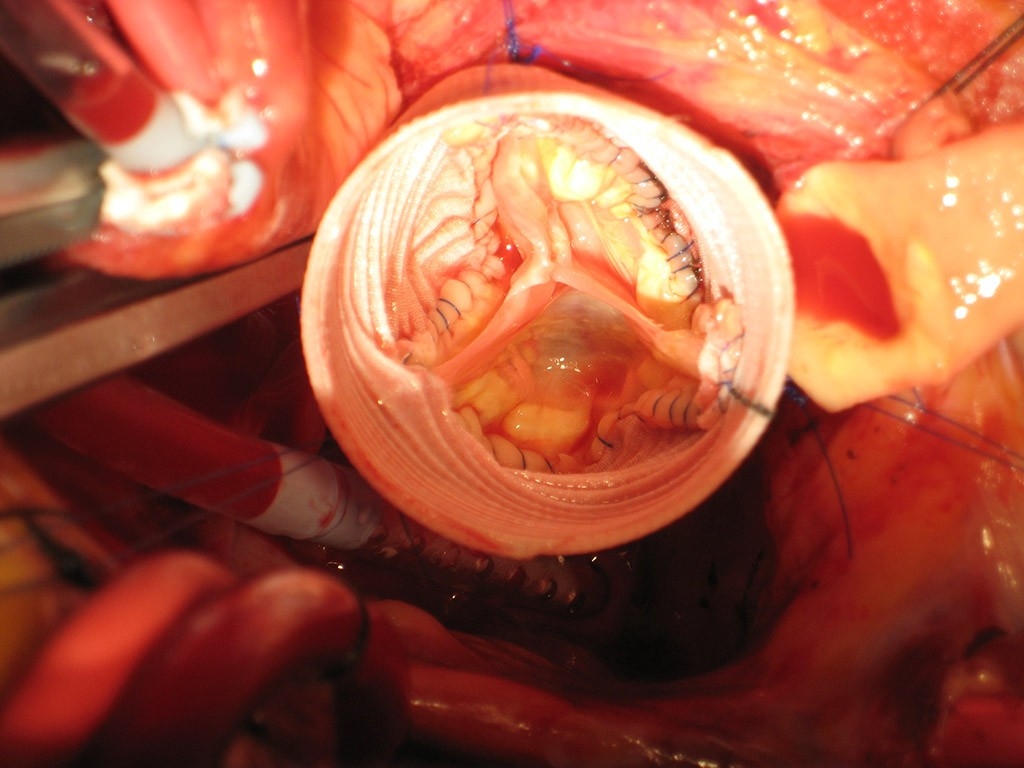 Photo of an aortic valve after being repaired