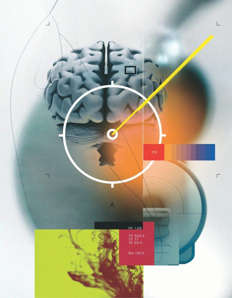 Laser-assisted brain surgery illustration by Stuart Bradford