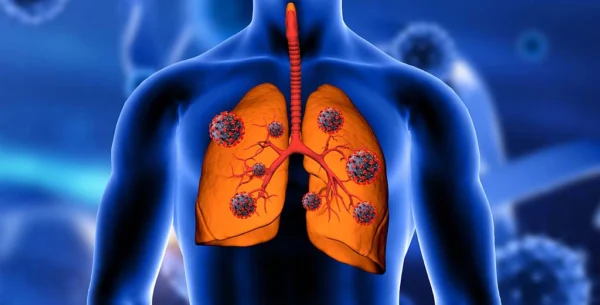 Illustration of SARS CoV-2 cells in someone's lungs