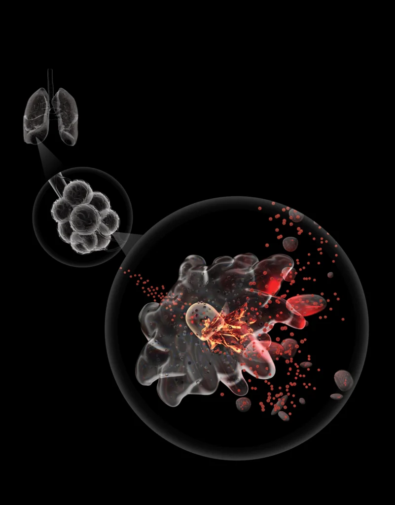An illustration of an interstitial macrophage infected by the virus SARS-CoV-2 spewing legions of virus and substances that trigger severe inflammation in the lungs.